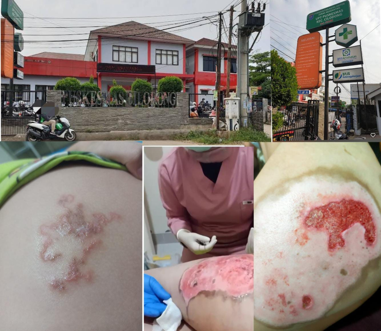 Ananda Zahra: Diduga Korban Mal Praktik Perawat dan Sang Dokter di Puskesmas Cilodong   